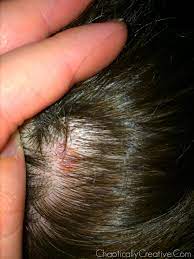 Sebaceous carcinoma may begin as a painless lump or thickening of skin on the eyelid. Common Moles Dysplastic Nevi And Risk Of Melanoma National Cancer Institute