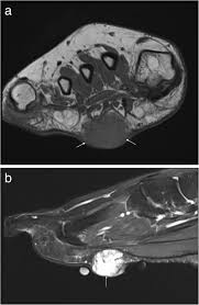 The muscles acting on the foot can be divided into two distinct groups; Mri Imaging Of Soft Tissue Tumours Of The Foot And Ankle Insights Into Imaging Full Text