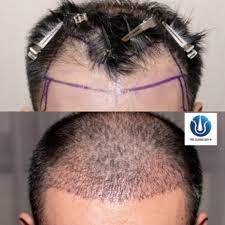 A hurricane and marketing woes couldn't keep these persistent franchisees down. Trapianto Capelli The Clever Guy Trapianto Di Capelli