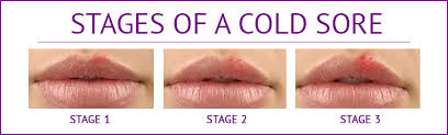Keep out of reach of children. How To Get Rid Of Cold Sores Fever Blisters Using An Abreva Cream