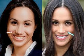 Meghan Markle Plastic Surgery Nose Job Teeth Before And After Blog Do Pin Meghan Markle Plastic Surgery Plastic Surgery Photos Nose Job