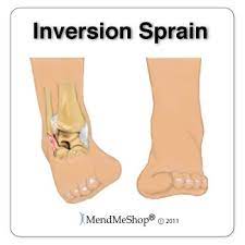 Body Tendons And Ligaments Google Search Peroneal Tendonitis Tendinitis Sprain