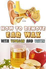 How To Remove Ear Wax With Vinegar And Water Mybeautybelieve Com Ear Wax Impacted Ear Wax Removal Ear Wax Removal
