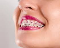 If you have traditional braces, think about the color bands you will choose. What Are The Best Colors For Braces University Dental San Diego
