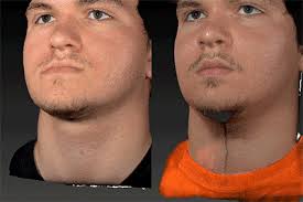 Orthognathic Jaw Surgery Houston The Woodlands Tx