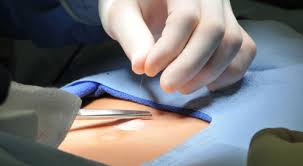 كم تستغرق عملية فتق السرة ومعلومات هامة عنها ويب طب