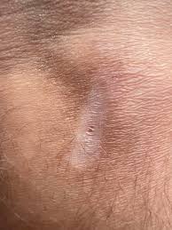 Image result for Postinflammatory Hypopigmentation