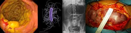 We did not find results for: Clostridioides Prev Clostridium Difficile Emcrit Project