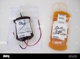Image result for Plasma Transfusion