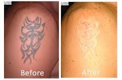 Ideas, hip tattoos, tattoo designs, custom ink, cool ink, tattoo removal, tattoo fonts,. Tattoo Removal Near Me