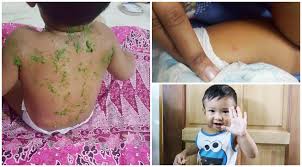 Demam campak pada bayi adalah masalah biasa yang sering terjadi ketika mereka sedang demam campak pada bayi boleh berjangkit! Chicken Pox Kering Dalam 7 Hari Ibu Ini Kongsi Tips Cara Penjagaannya