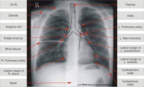 Check spelling or type a new query. Chest X Ray Dr Tariq Naik Interventional Radiology Facebook