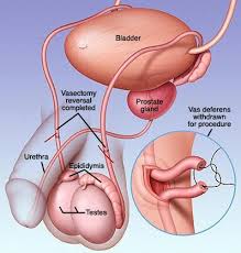 Image result for Vasectomy