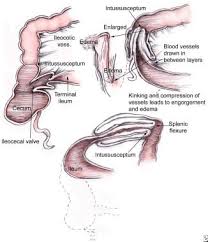 Image result for Intussusception