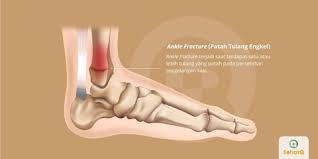 Alat ukur telapak kaki yang terdiri dari. Ankle Fracture Patah Tulang Engkel Tanda Dan Gejala Penyebab Cara Mengobati Cara Mencegah