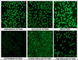 Image result for ANA Staining Pattern