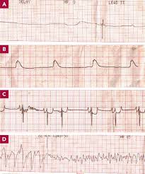 Critical Components To Successful Cpr The Recover