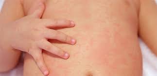 Isilik Nedir Neden Olur Isilige Ne Iyi Gelir Belirtileri Ve Tedavisi