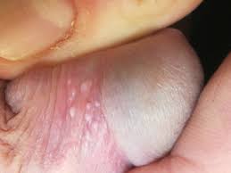 Tyson Glands Or Warts? Conflicting Diagnosis! (Pics) | Penis Disorders |  Forums | Patient