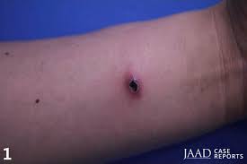 The american journal of the medical sciences by southern society for clinical investigation (u.s.) (1836) 1. Jaad Journals On Twitter Self Healing Eschar Like Erythematous Nodules What S The Diagnosis A Sweet Syndrome B Mucormycosis C Nasal Type Extranodal Natural Killer T Cell Lymphoma D Cutaneous Anaplastic Large Cell Lymphoma E Lymphomatoid Papulosis