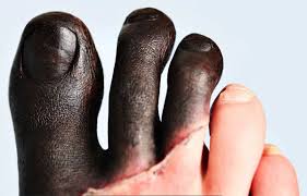 Image result for toe black diabetes
