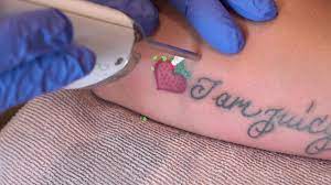 Tip Don T Record Laser Tattoo Removal Https Youtu Be B3mzobrgaa0 Laser Tattoo Laser Tattoo Removal Tattoo Removal