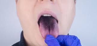 Image result for black tongue symptoms
