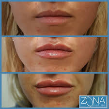 Lips before and after 1 syringe of juvederm | yelp. Pin On Before After Pictures