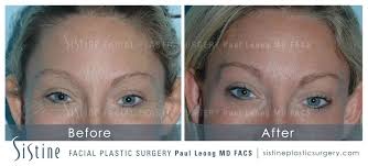 How does botulinum toxin (botox) work? Botox Pittsburgh Dr Paul Leong
