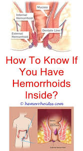 Pin On Hemorrhoids Symptoms