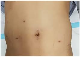 Especialista En Hernias En Satelite Dr Gustavo Gomez