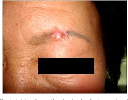 Understanding liver cancer is important if you want to develop an effective treatment plan and live a long and healthy life. Pdf Basal Cell Carcinoma Arising In A Tattooed Eyebrow Semantic Scholar