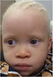 Genotypic spectrum of albinism in Mali