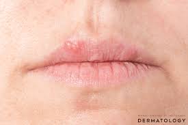 Image result for oral herpes symptoms roof of the mouth