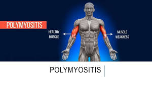 Image result for Polymyositis