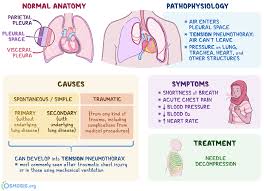 External blood loss is usually obvious yet occult bleeding can be challenging for the provider to recognise and manage in its early stages. Tension Pneumothorax What Is It Causes Signs Symptoms Diagnosis Treatment And More Osmosis