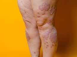 Image result for psoriasis