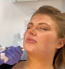 Which is better? Sculptra or Radiesse?