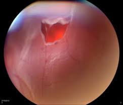Jun 12, 2021 · parrina et al from government hospital, chandigarh reported an interesting case of rhegmatogenous retinal detachment with giant retinal tear in a child with marfanoid features. Retina Louisville Retinal Detachment Louisville Bennett Bloom