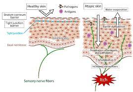 The latex contains ficin, a proteolytic enzyme that causes pruritus, and acts as an irritant on inflamed skin. Biomedicines Free Full Text Intractable Itch In Atopic Dermatitis Causes And Treatments Html