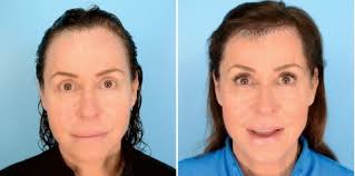 Have No Fear… Because Bauman Medical Hair Transplants are Here!