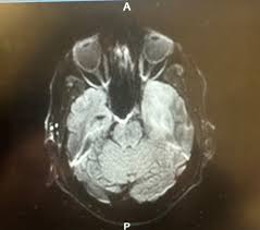 Image result for HSV Encephalitis