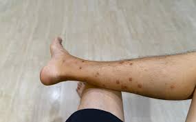Image result for liver spots on legs