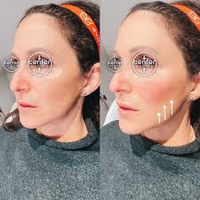 CHEEKS, PLEASE! 🍎 Lift & refresh with one syringe of filler for this  lovely patient! @centermedspachatt @bestaestheticinjectors  #chattanoogamedspa #chattanoogaaesthetics #chattanoogainjector