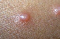 Causes, treatment, removal and pictures collection. Bumps On Scrotum