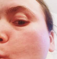 Tips On How To Prevent Allergy Face Allergyface Zyrtec Ad Prevent Allergies Face Allergies