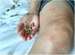 It's an autoimmune disease, which means that your immune system — the body system that usually fights infections — attacks healthy tissue instead. What Is Lupus