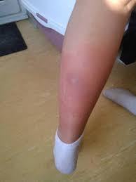 Image result for spinne biss haut reaktion