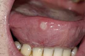 It may take several weeks, or up to months, for leukoplakia to resolve itself.3 treatment of leukoplakia is aimed at preventing cancer. the white patches are often removed, but often they will spontaneously reappear. other forms of intervention for the treatment of leukoplakia include:4 1. Mouth Ulcers Hse Ie