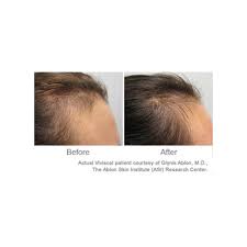 While there are a number of products that have helped with my hair loss issues, viviscal has been vital in my hair loss journey. Viviscal Professional 60 Tablets Prevent Hair Loss Jag Cosmetics